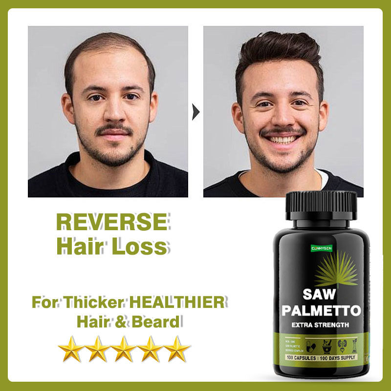 ผู้ผลิตอาหารเสริม Saw Palmetto Capsules ความแข็งแรงเพิ่มเติมเพื่อลดการสูญเสียผมสนับสนุนการเติบโต